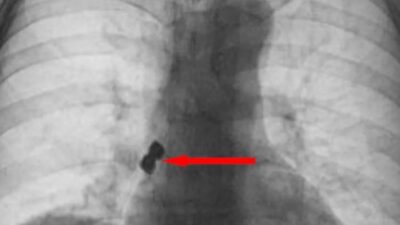 Afyonkarahisar’da 56 yaşındaki bir şahıs tedavi için gittiği diş kliniğinde