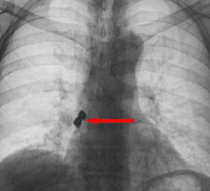 Afyonkarahisar’da 56 yaşındaki bir şahıs tedavi için gittiği diş kliniğinde
