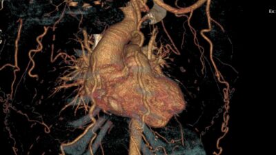 Tıp literatüründe nadir görülen, çok büyük bir aort anevrizmasının yanı