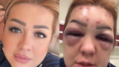 Kahramanmaraş'ta bir kadın yaptırdığı botoks sonrası yüzü şişerek hastanelik oldu.