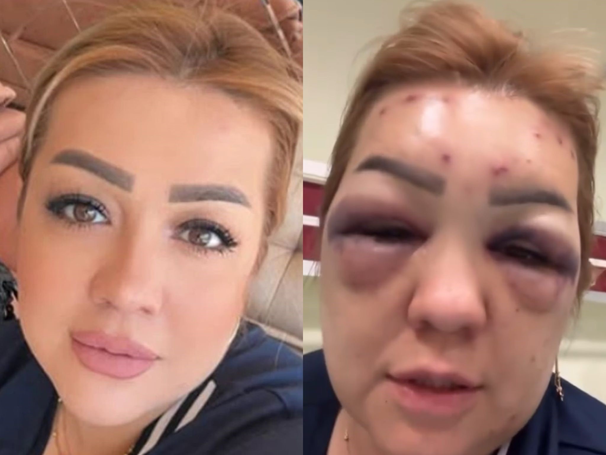 Kahramanmaraş'ta bir kadın yaptırdığı botoks sonrası yüzü şişerek hastanelik oldu.