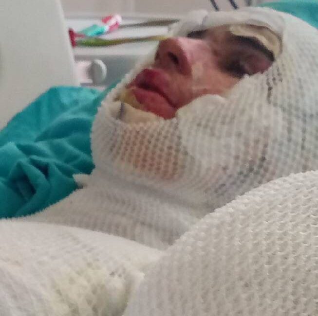 Adana'da bir şahıs, 16 yaşındaki yeğeninin üzerine yanıcı madde dökerek