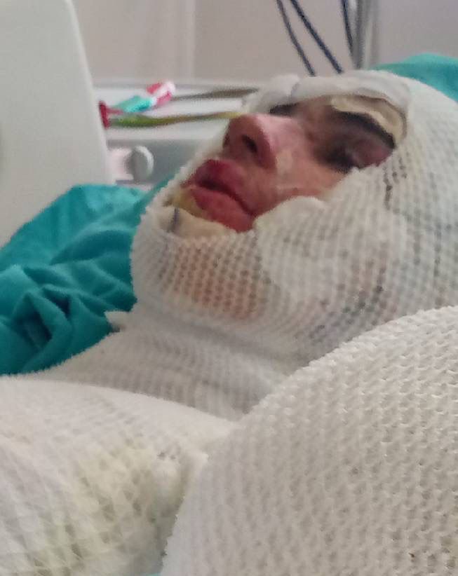 Adana'da bir şahıs, 16 yaşındaki yeğeninin üzerine yanıcı madde dökerek