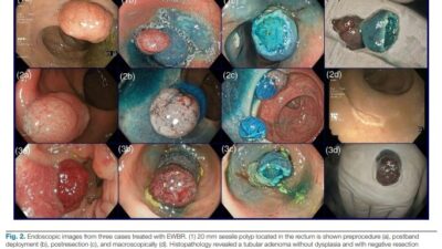 Denizli’de görev yapan Doç. Dr. Ufuk Kutluana’nın geliştirdiği EWBR (Endoscopic