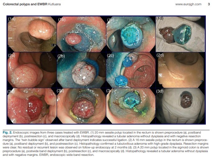 Denizli’de görev yapan Doç. Dr. Ufuk Kutluana’nın geliştirdiği EWBR (Endoscopic