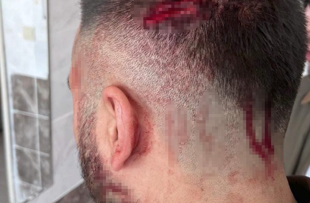 Öğretmen, veli tarafından sopayla darbedildi Şanlıurfa’nın Haliliye ilçesinde bir ilkokul öğretmeni, veli tarafından sopayla darbedildi.