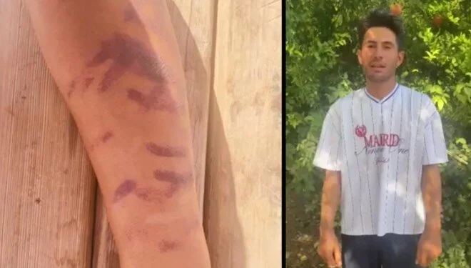 Lazer epilasyon kabusu: Vücudu yandı Gaziantep'in Nizip ilçesinde lazer epilasyon için bir güzellik merkezine giden