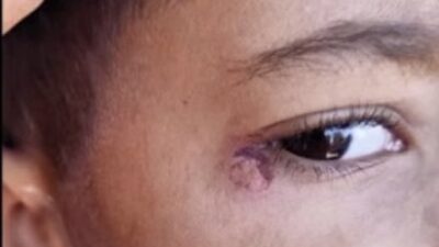 Şanlıurfa Harran Koyunluca İlkokulu'nda 7 yaşındaki Mustafa B.'nin yüzünde sigara