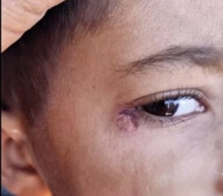 Temizlik görevlisinin sigara söndürme şiddeti: 7 yaşındaki öğrenci yaralandı, şüpheli tutuklandı Şanlıurfa Harran Koyunluca İlkokulu'nda 7 yaşındaki Mustafa B.'nin yüzünde sigara