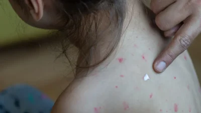 Kanada’da son bir yıldır süren kızamık salgını nedeniyle ülke, “kızamıktan