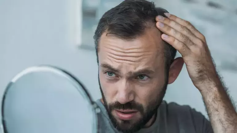 Erkek tipi saç dökülmesi tedavisinde kayda değer bir ilerlemenin görülmediği