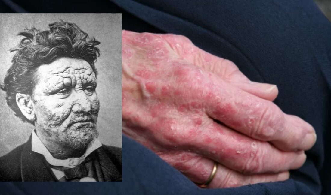 Avrupa'da onlarca yıldır görülmeyen cüzzam hastalığı, Romanya ve Hırvatistan'dan gelen