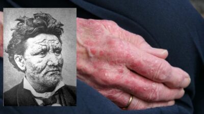 Avrupa'da onlarca yıldır görülmeyen cüzzam hastalığı, Romanya ve Hırvatistan'dan gelen