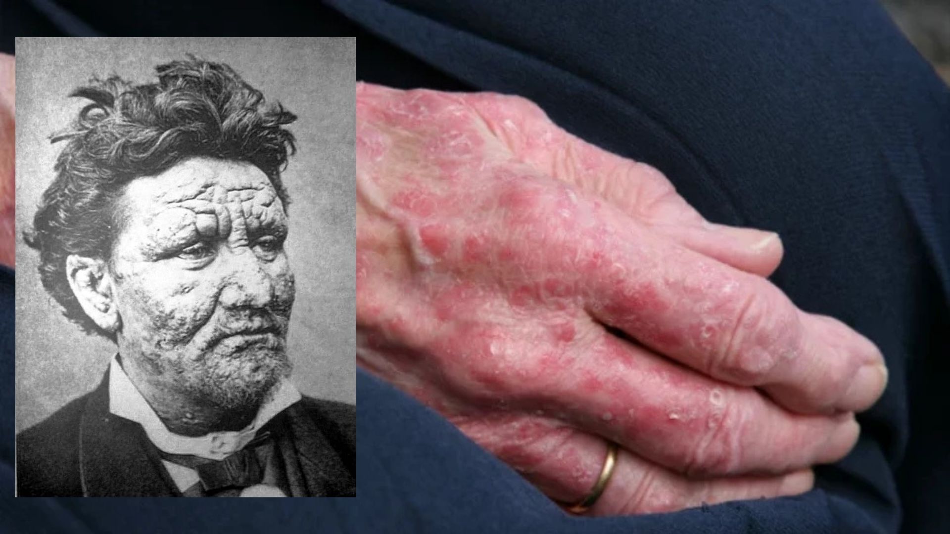 Avrupa'da onlarca yıldır görülmeyen cüzzam hastalığı, Romanya ve Hırvatistan'dan gelen