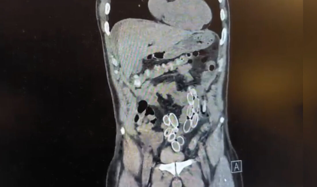 Karnı ağrıyan adam hastaneye gitti, doktorlar hemen tomografiye aldı. Sonucu