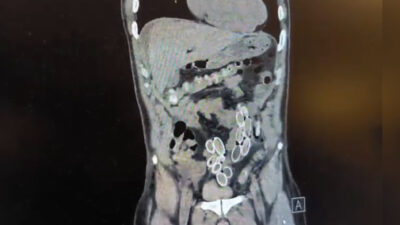 Karnı ağrıyan adam hastaneye gitti, doktorlar hemen tomografiye aldı. Sonucu