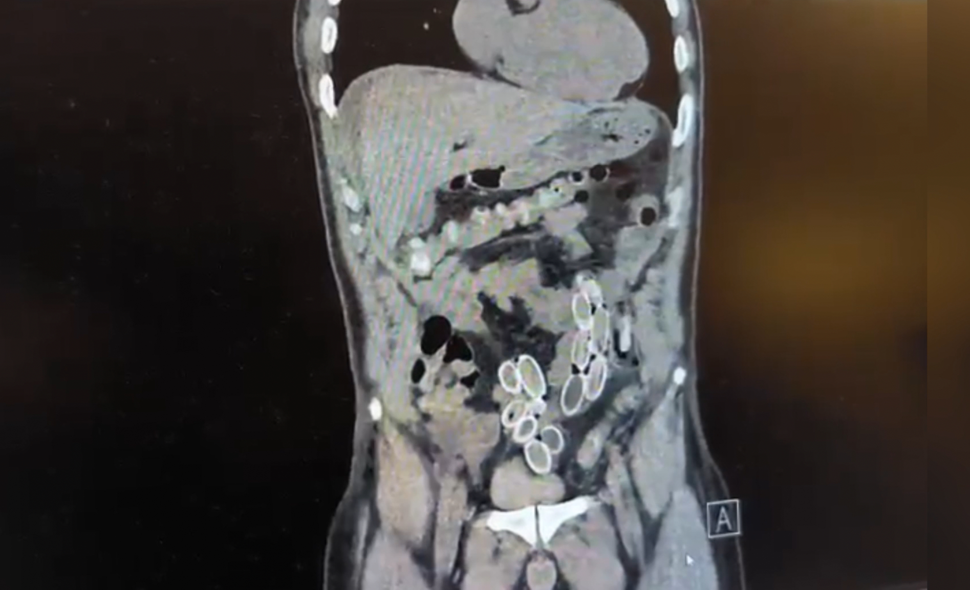 Karnı ağrıyan adam hastaneye gitti, doktorlar hemen tomografiye aldı. Sonucu