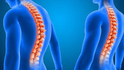 Skolyozun çoğu zaman sinsi ilerleyebildiğini söyleyen Sallı, “Omuz seviyesinde asimetri,