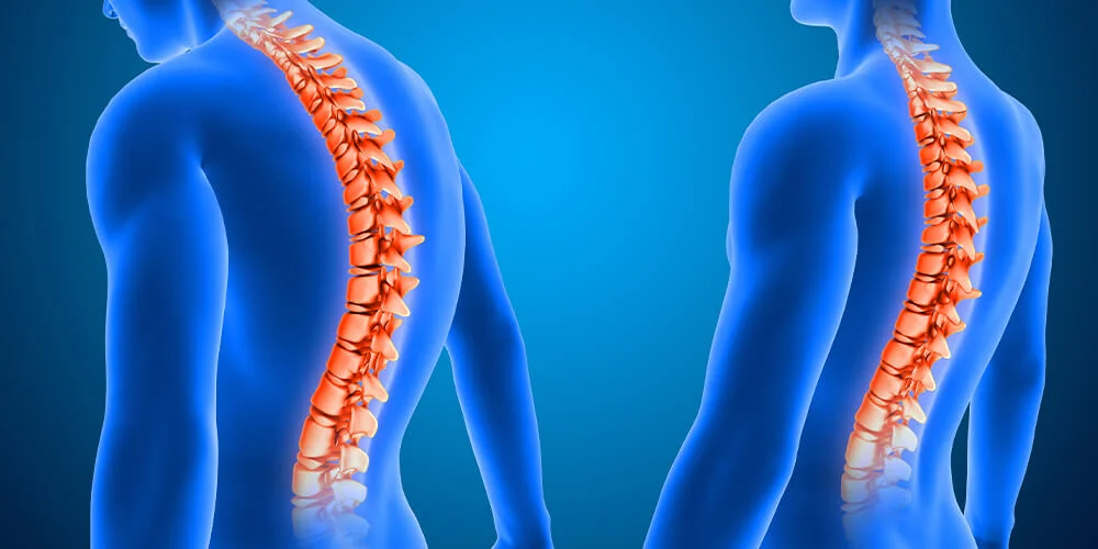 Skolyozun çoğu zaman sinsi ilerleyebildiğini söyleyen Sallı, “Omuz seviyesinde asimetri,