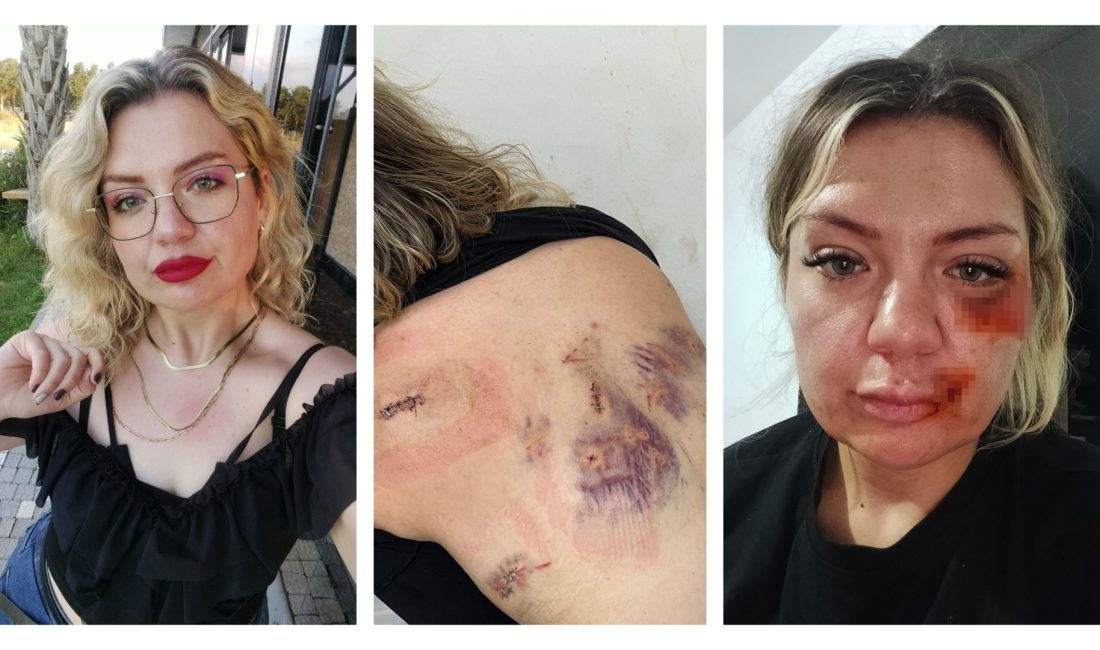 Antalya'da, cezaevinden izinli çıkan eski erkek arkadaşının bıçaklı saldırısında başından,