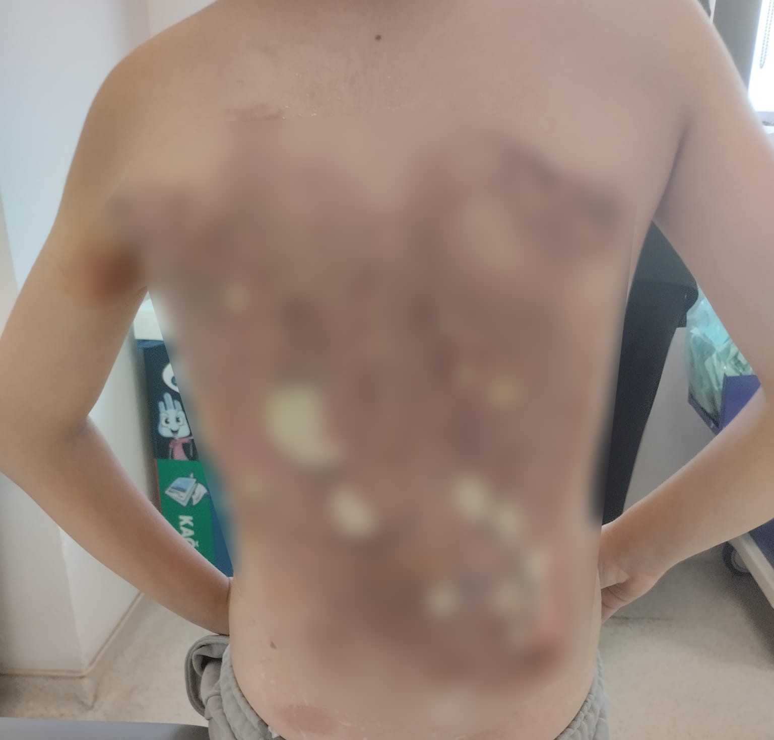 12 yaşındaki çocuğun sırtını kolonya ile yaktılar