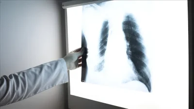 Türk Göğüs Cerrahisi Derneği Başkanı Prof. Dr. Atilla Eroğlu, akciğer